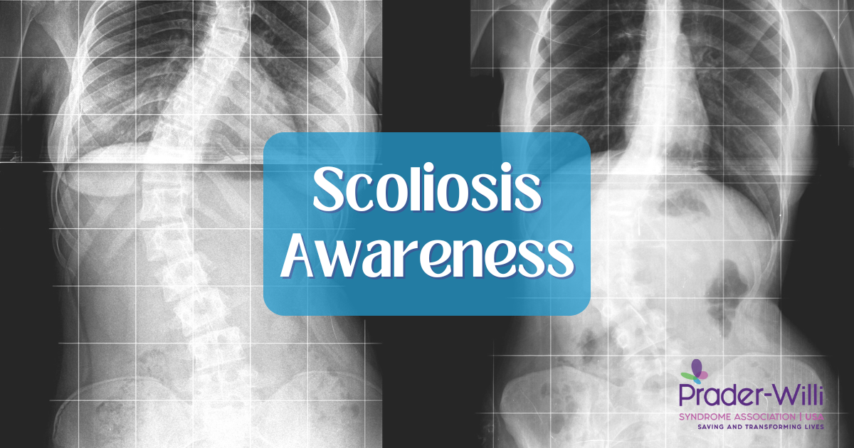 two x-ray images of adults with Prader-Willi syndrome and scoliosis